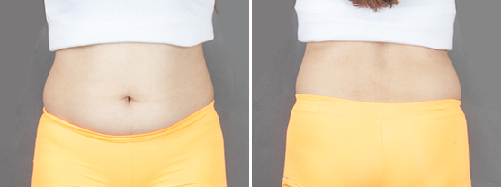 Before and after comparison of abdominal liposuction performed at 365mc in Korea to remove stubborn belly fat.