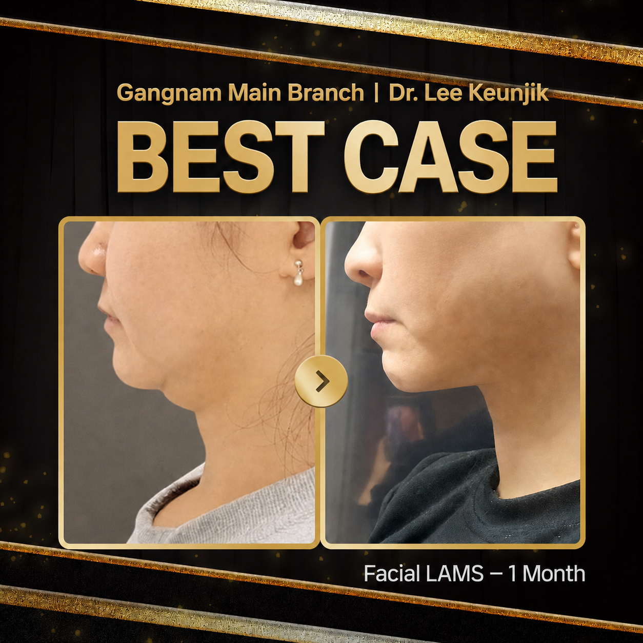 365mc Facial LAMS