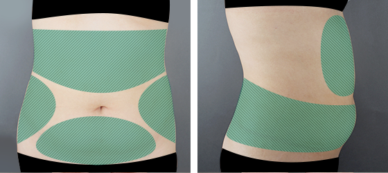 Diagram illustrating upper and lower abdominal fat zones treated during tummy liposuction procedures.