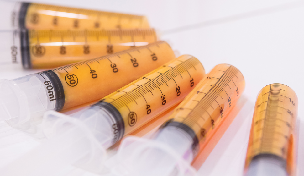 Syringes filled with purified fat extracted during the 365mc LAMS liposuction procedure under local anesthesia.