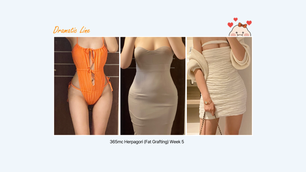 Herpagori fat grafting before and after result showing enhanced body contouring by 365mc Korea