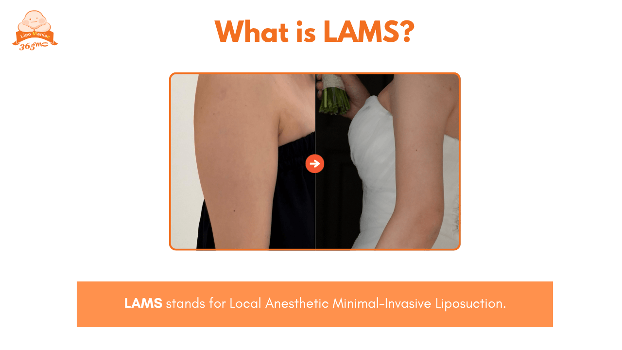 before and after arm contouring results from 365mc lams procedure