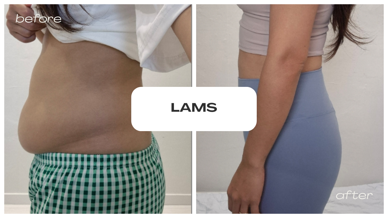 Before and after results of the 365mc LAMS procedure showing visible abdominal contour improvement and reduced fat.