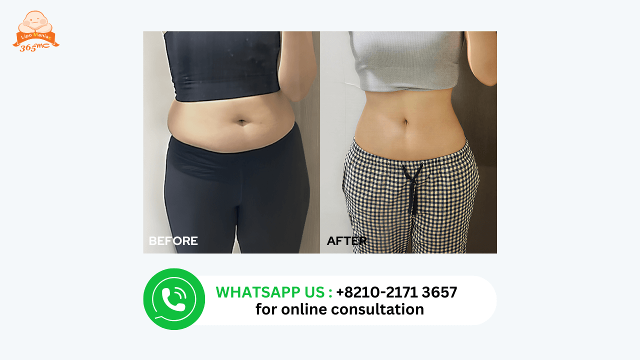 Before and after abdominal liposuction results at 365mc Korea