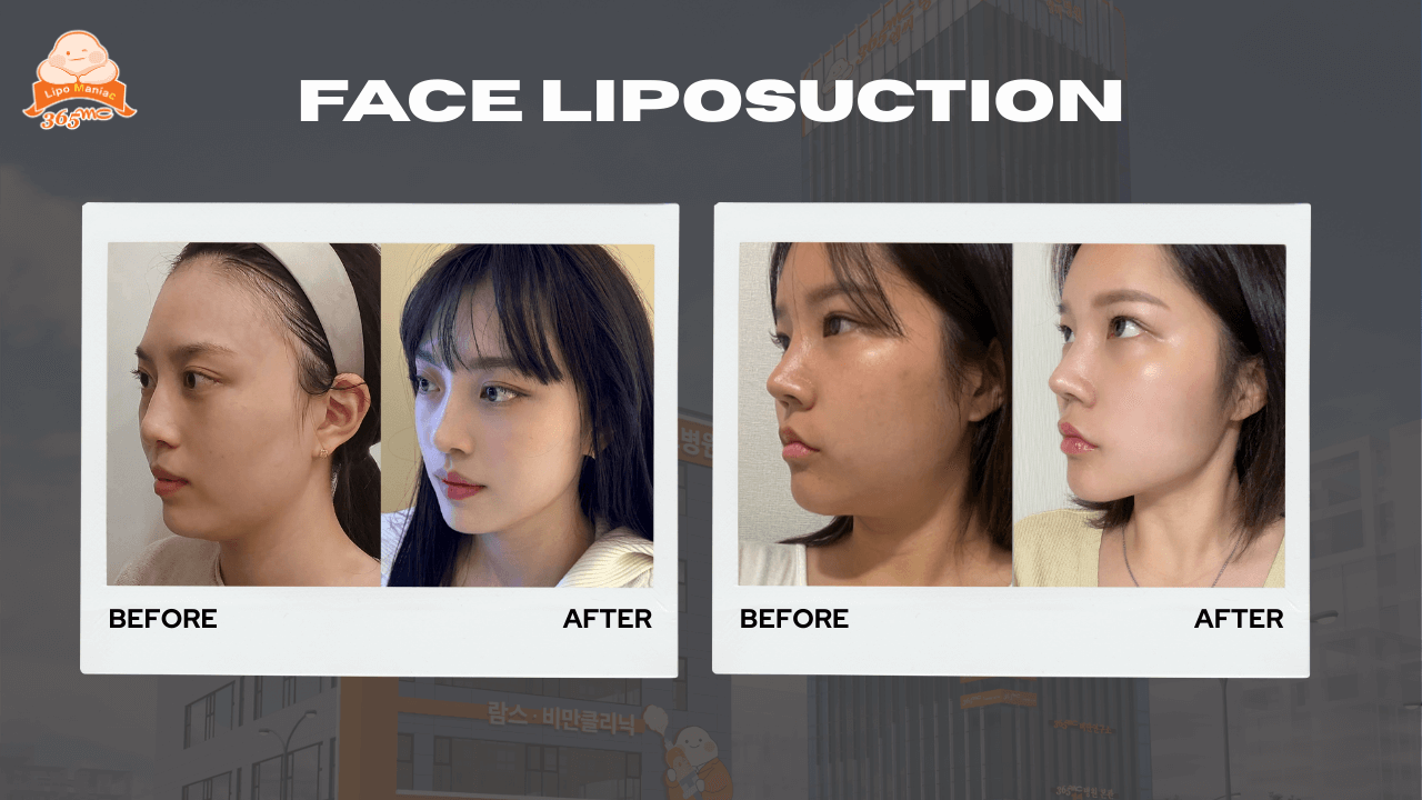 Side profile before and after facial liposuction showing improved jawline definition