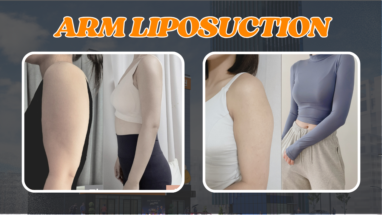 Before and after results showing slimmer, more defined arms achieved through 365mc’s specialized arm liposuction procedure.