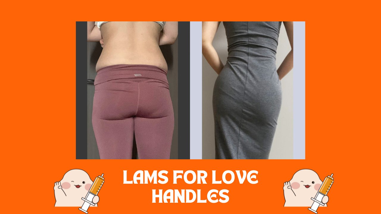 Compression Garment and Liposuction - 365mc medical expertise and patient care