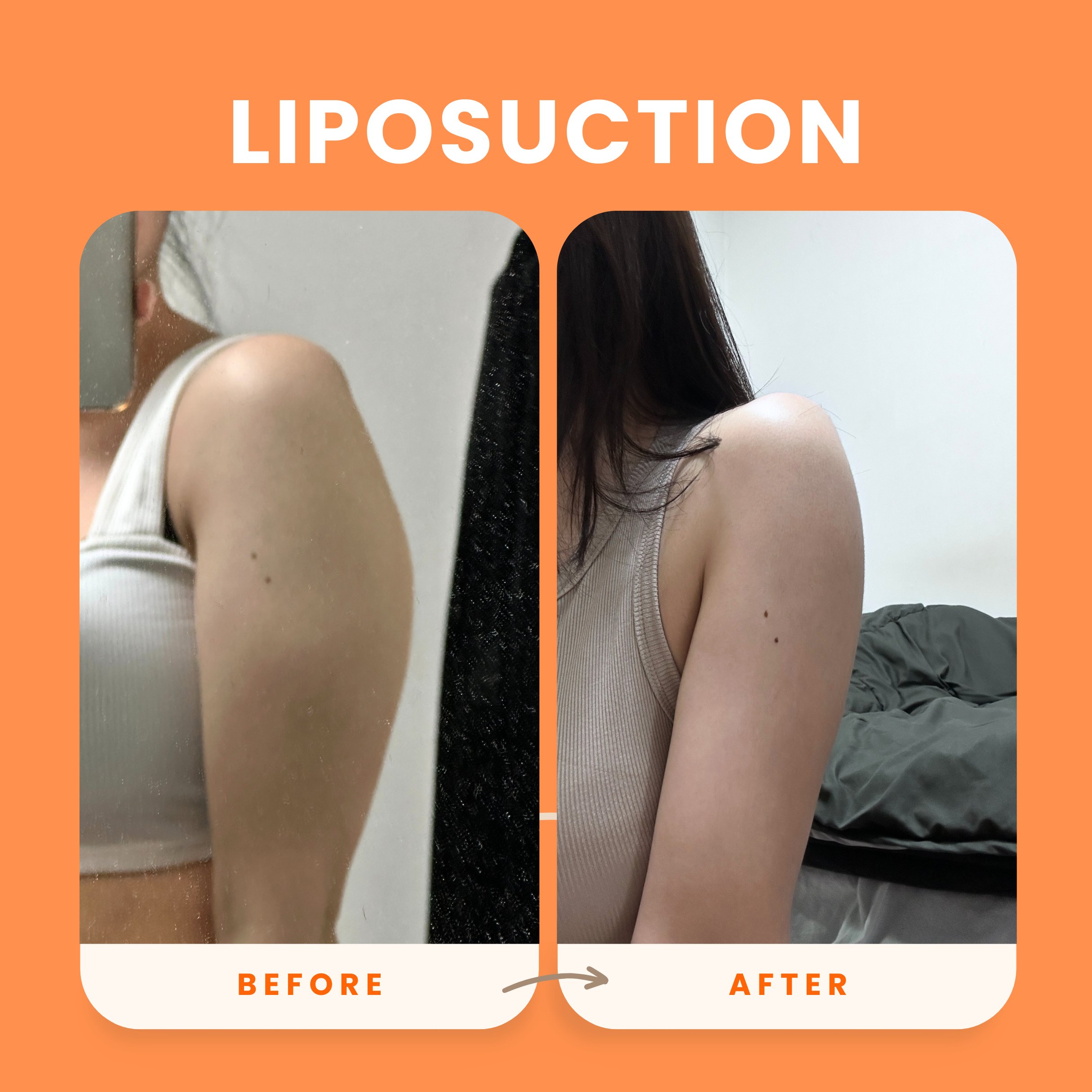 Achieving the Best Results After Liposuction / LAMS - 365mc medical expertise and patient care