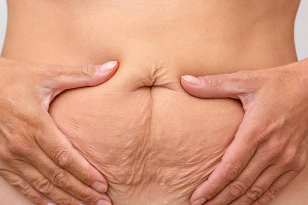 Saggy Skin and Liposuction: What You Need to Know - 365mc medical expertise and patient care