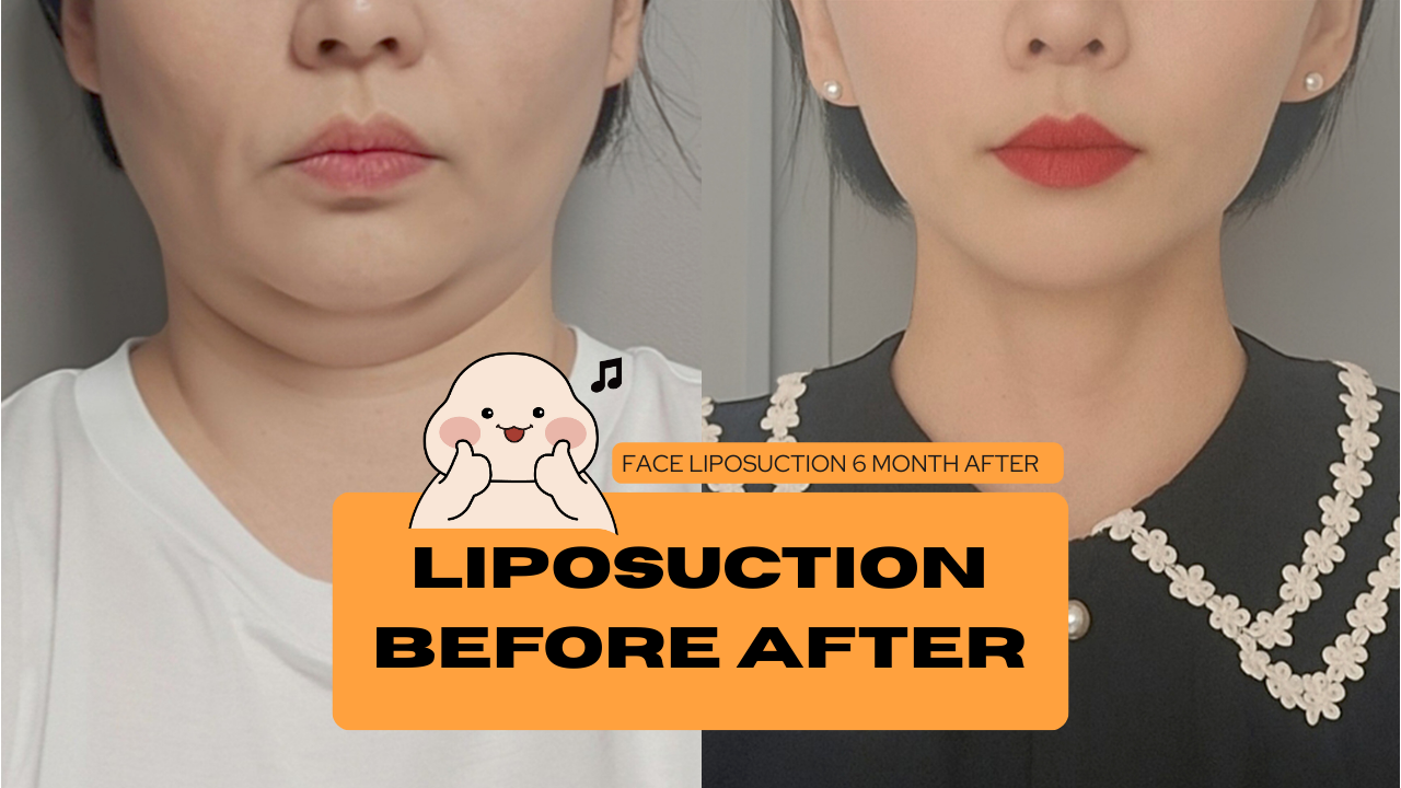 365mc Liposuction Before and After - 365mc medical expertise and patient care