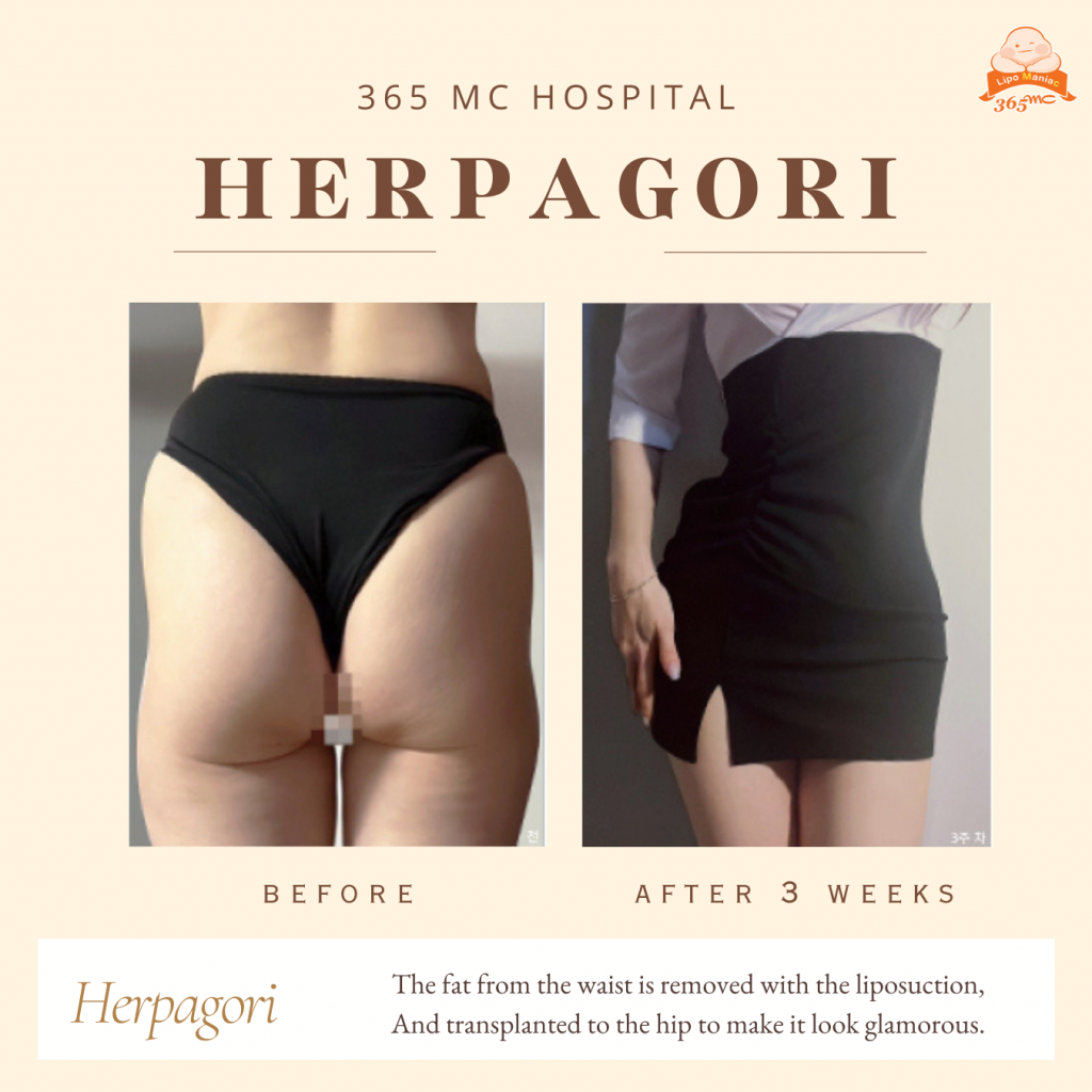 Herpagori Before After