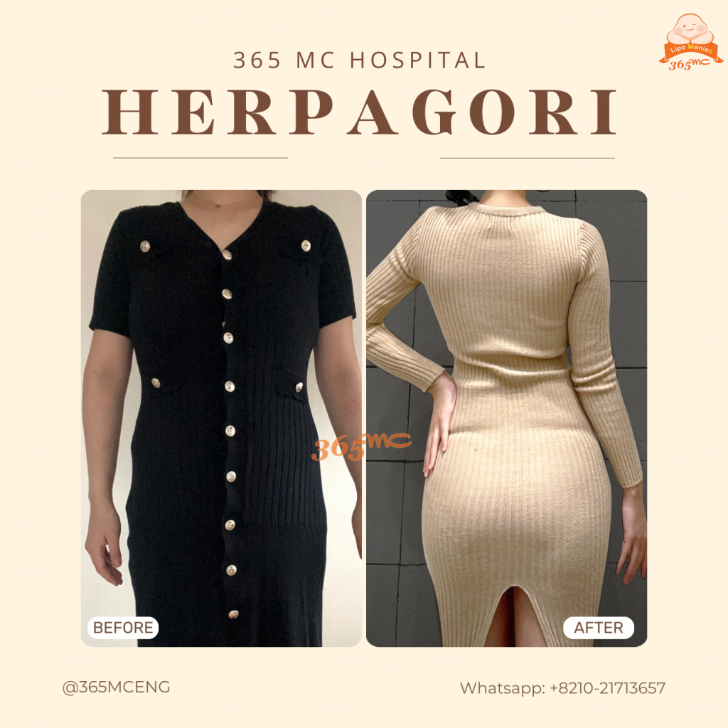 Herpagori Before After