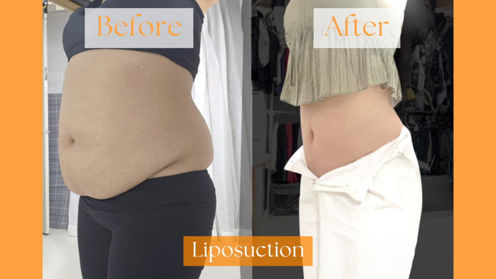 [IMAGE 3 Lipo]