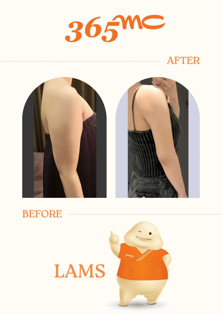 Cartoon character jogging after LAMS liposuction recovery