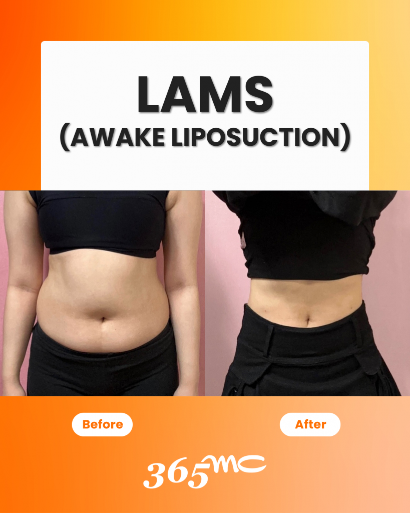 IMAGE2Awake 819x1024 LAMS procedure educational information and patient care details