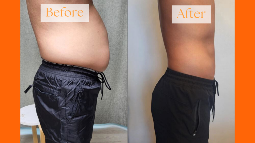 Liposuction procedure information and patient care guidance