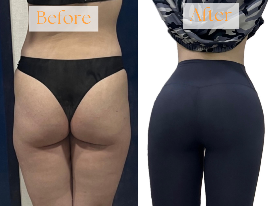 experience of Liposuction