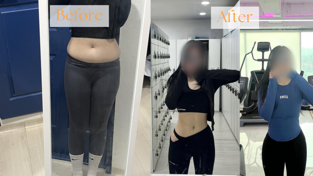 Liposuction procedure information and patient care guidance