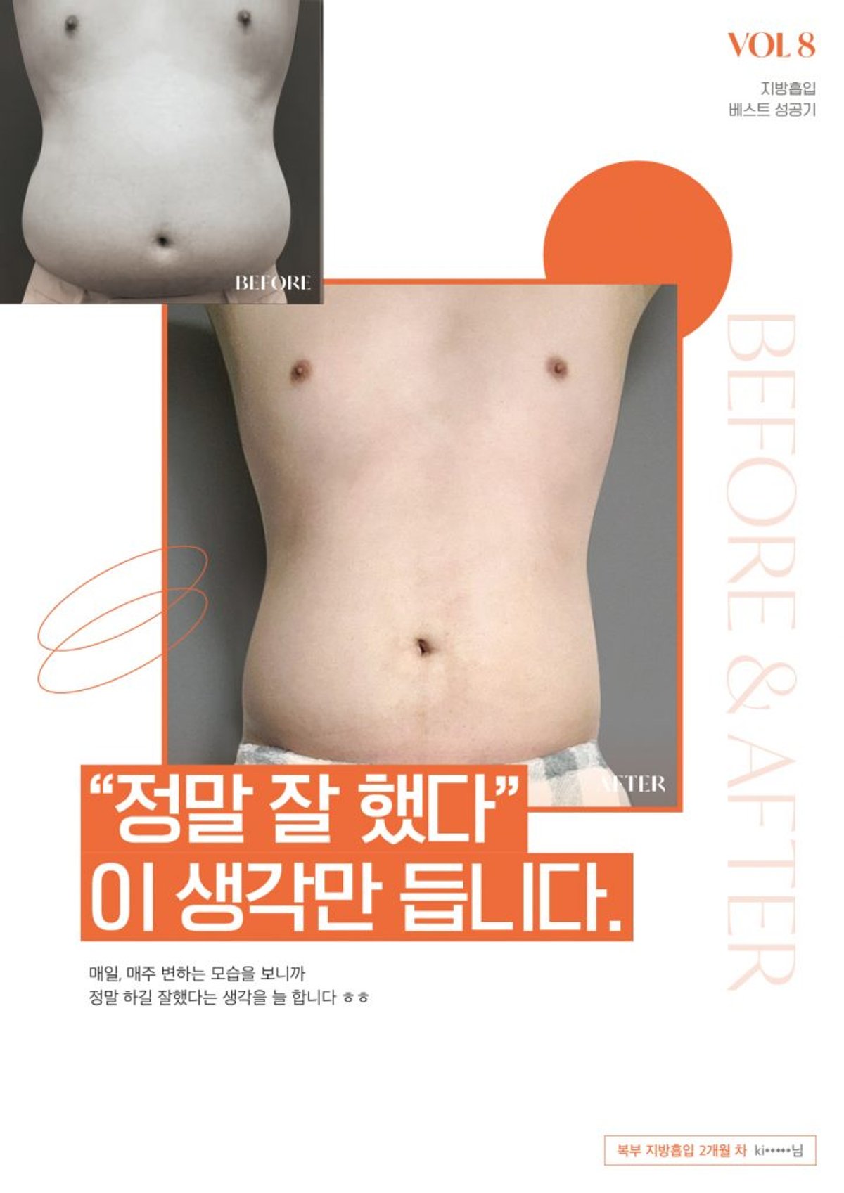 Male abdomen liposuction before and after result at 365mc