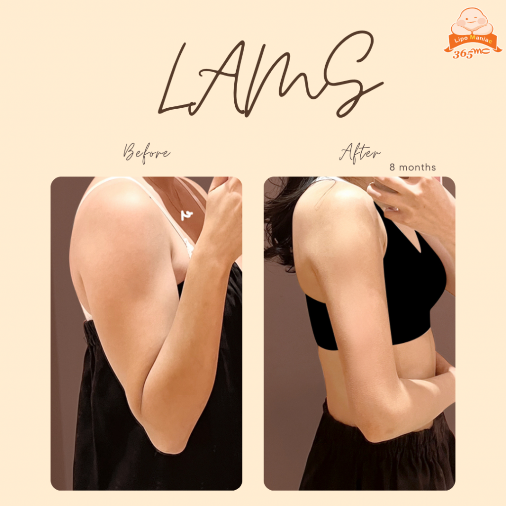 Preparing For Liposuction: A Step By Step Guide - 365mc medical expertise and patient care