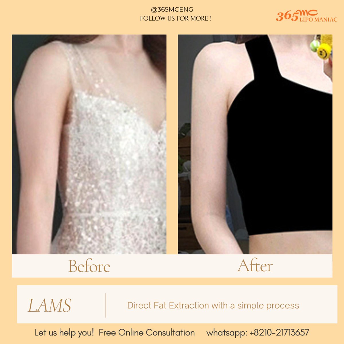 What to do after LAMS? - 365mc medical expertise and patient care