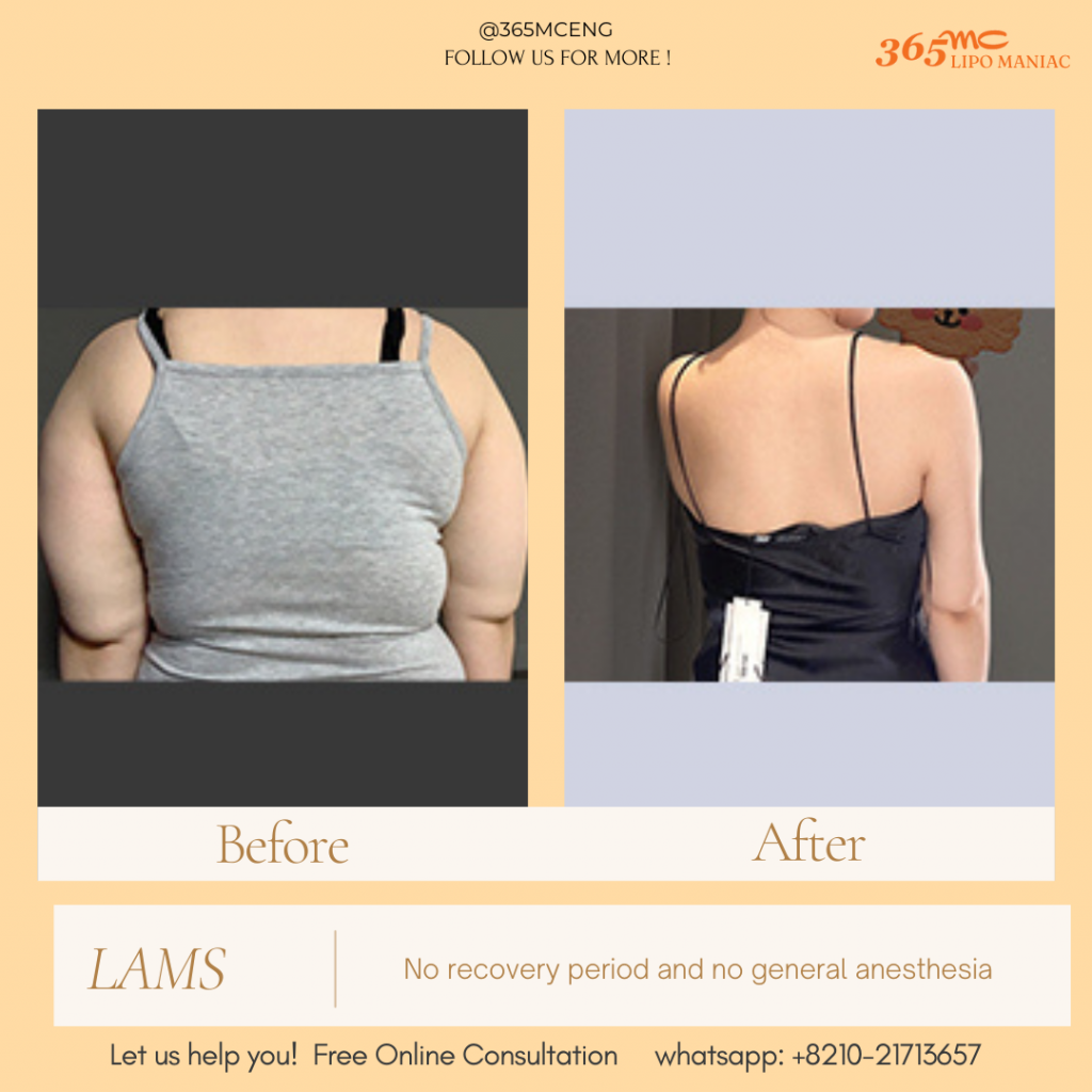 img 7 LAMS is the best solution