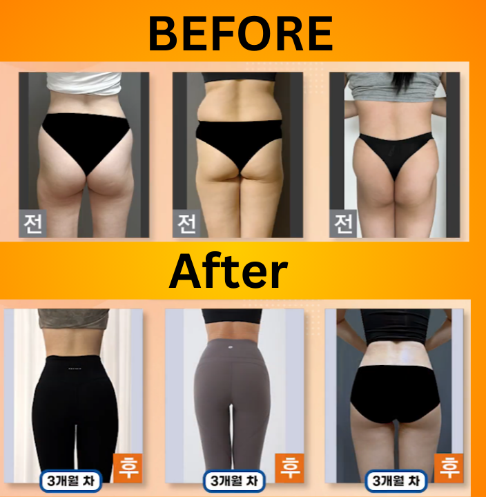 liposuction-review-before-after-herpargori-365mc