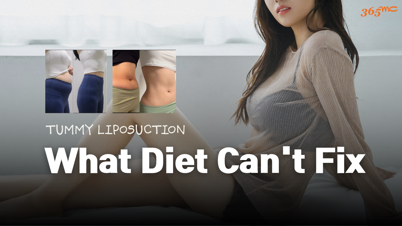 Tummy Liposuction in Korea: Targeting Stubborn Fat Diet Can’t Fix - 365mc medical expertise and patient care